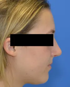 After Revision rhinoplasty before and after
