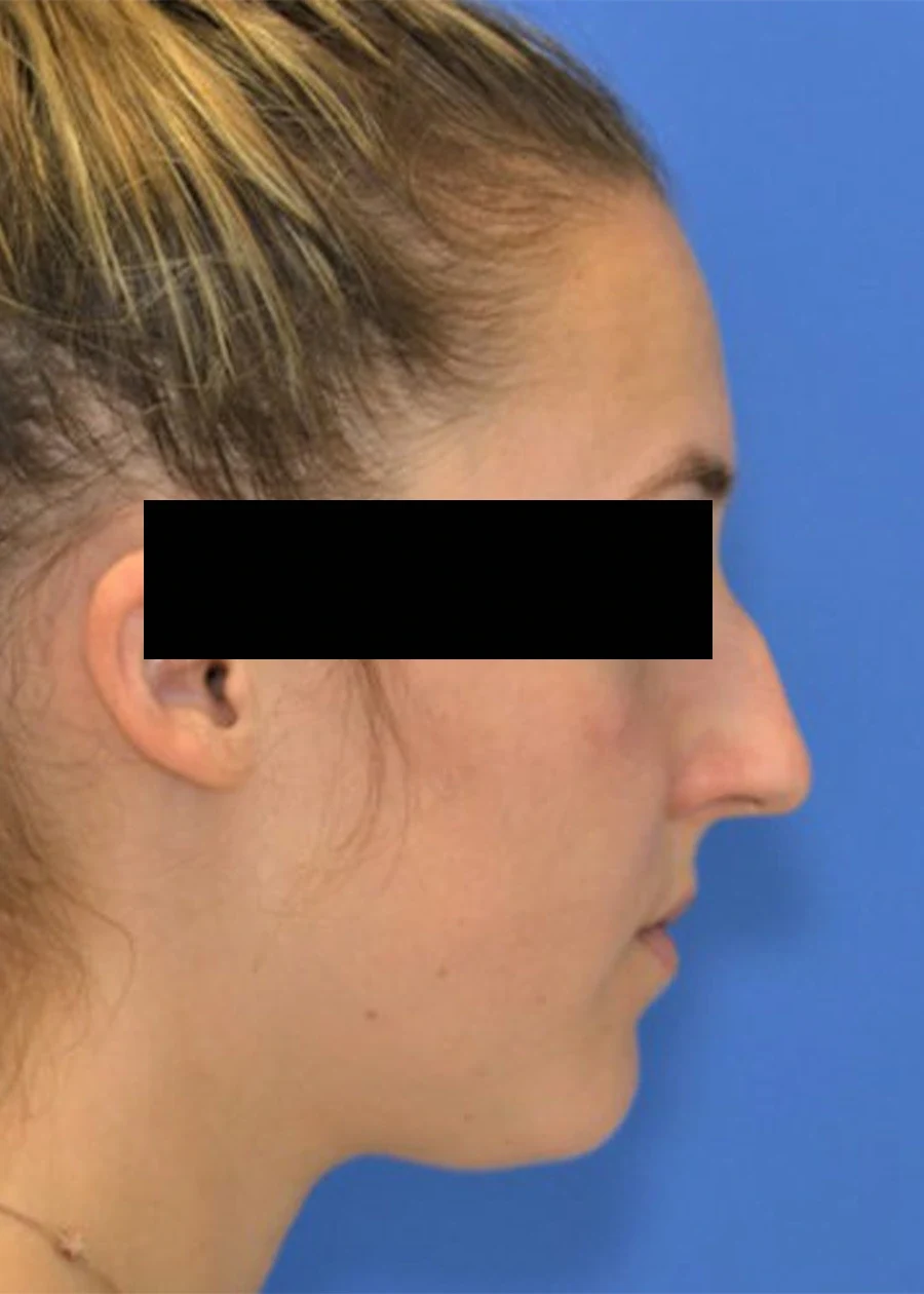 Before Revision rhinoplasty before and after