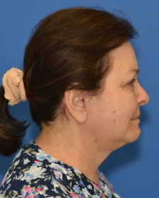 After Neck lift before and after