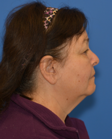 Before Neck lift before and after