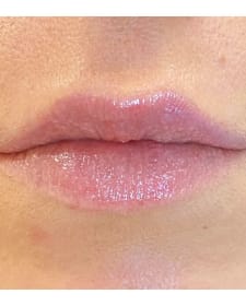 After Lip augmentation before and after