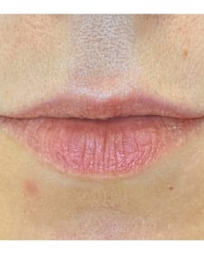 Before Lip augmentation before and after
