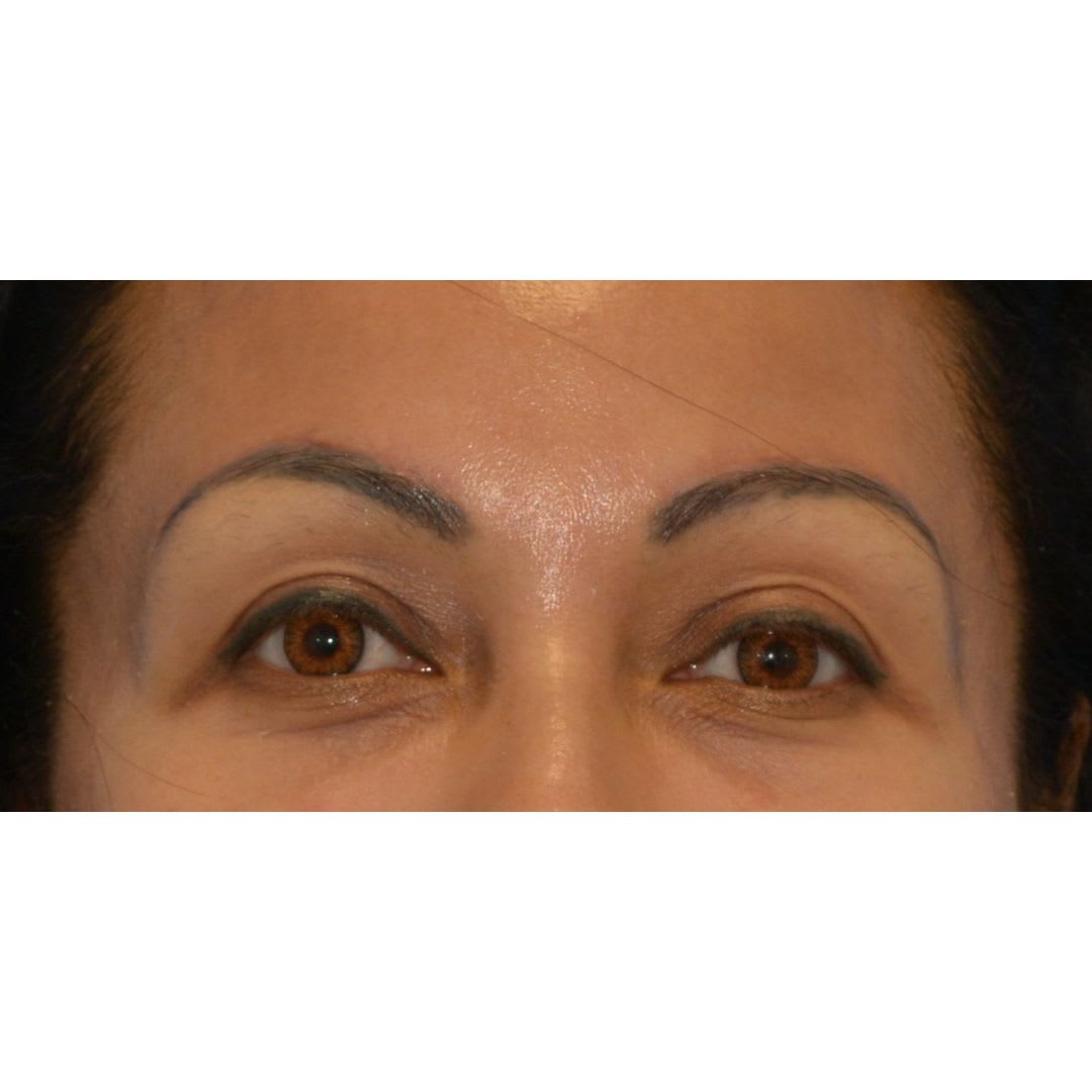 After Brow lift before and after
