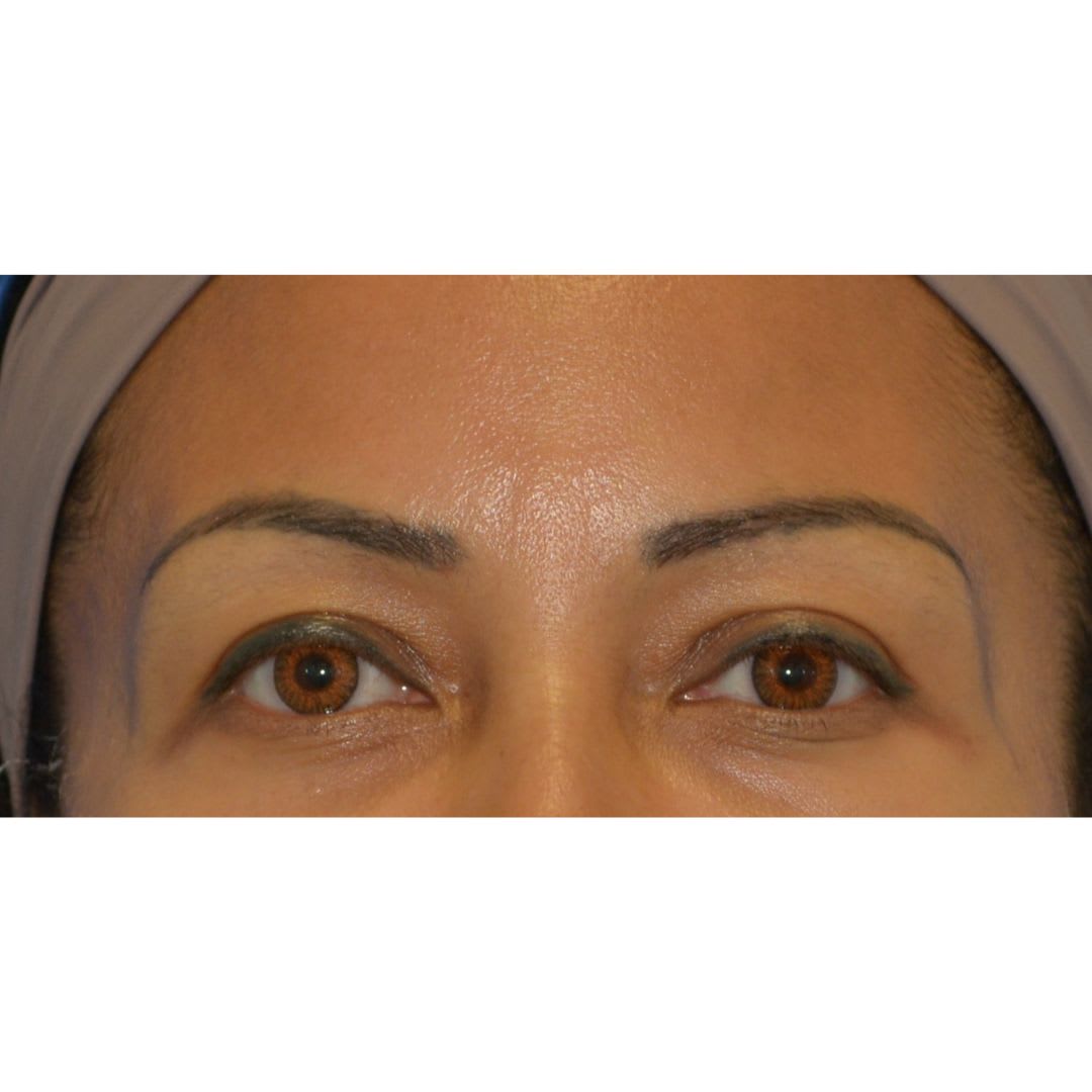 Before Brow lift before and after