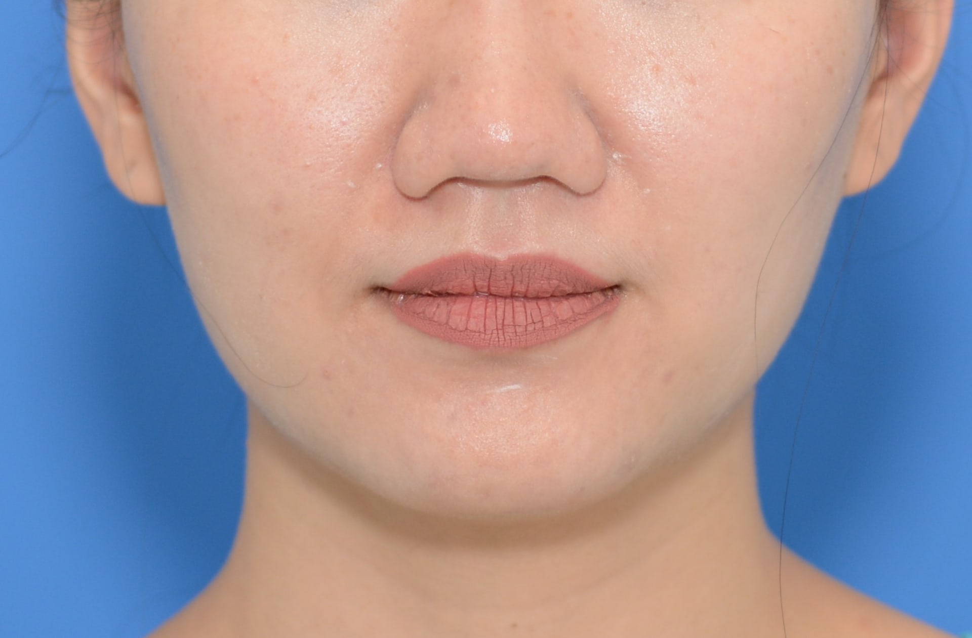 After Dysport before and after