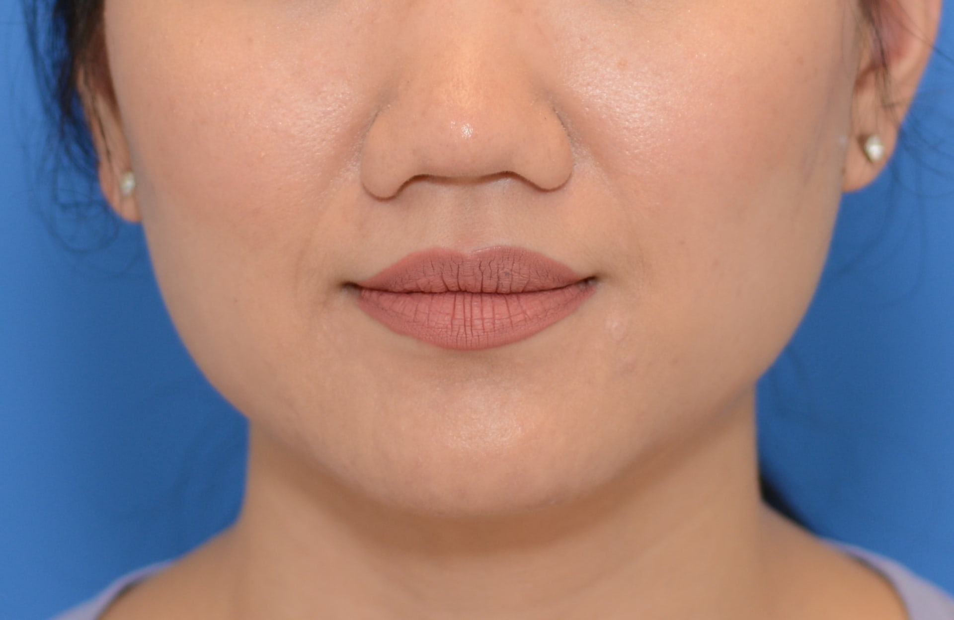 Before Dysport before and after