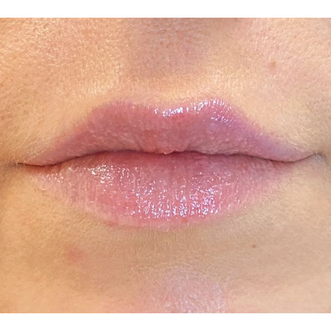 After Lip enhancement before and after