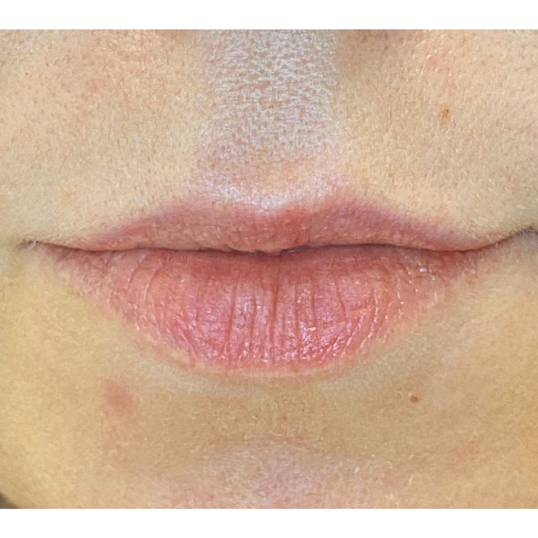 Before Lip enhancement before and after