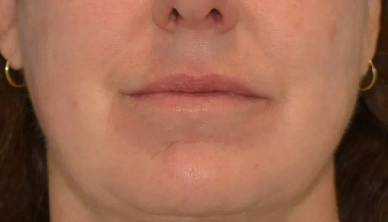 After laser treatments before and after