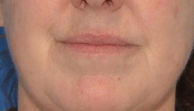 Before laser treatments before and after