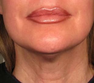 After Ultherapy before and after