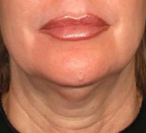 Before Ultherapy before and after