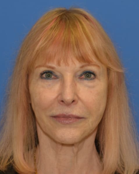 After Liquid Facelift before and after