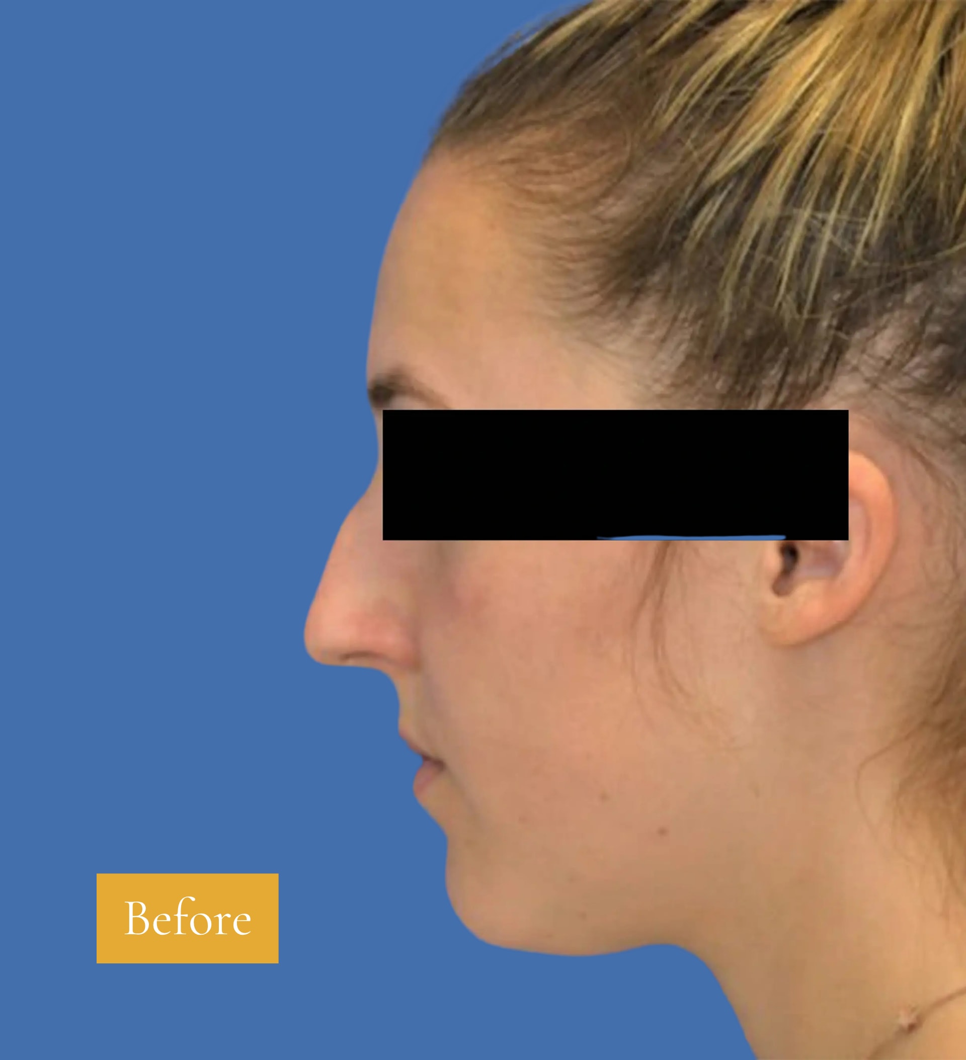 Before Rhinoplasty before and after