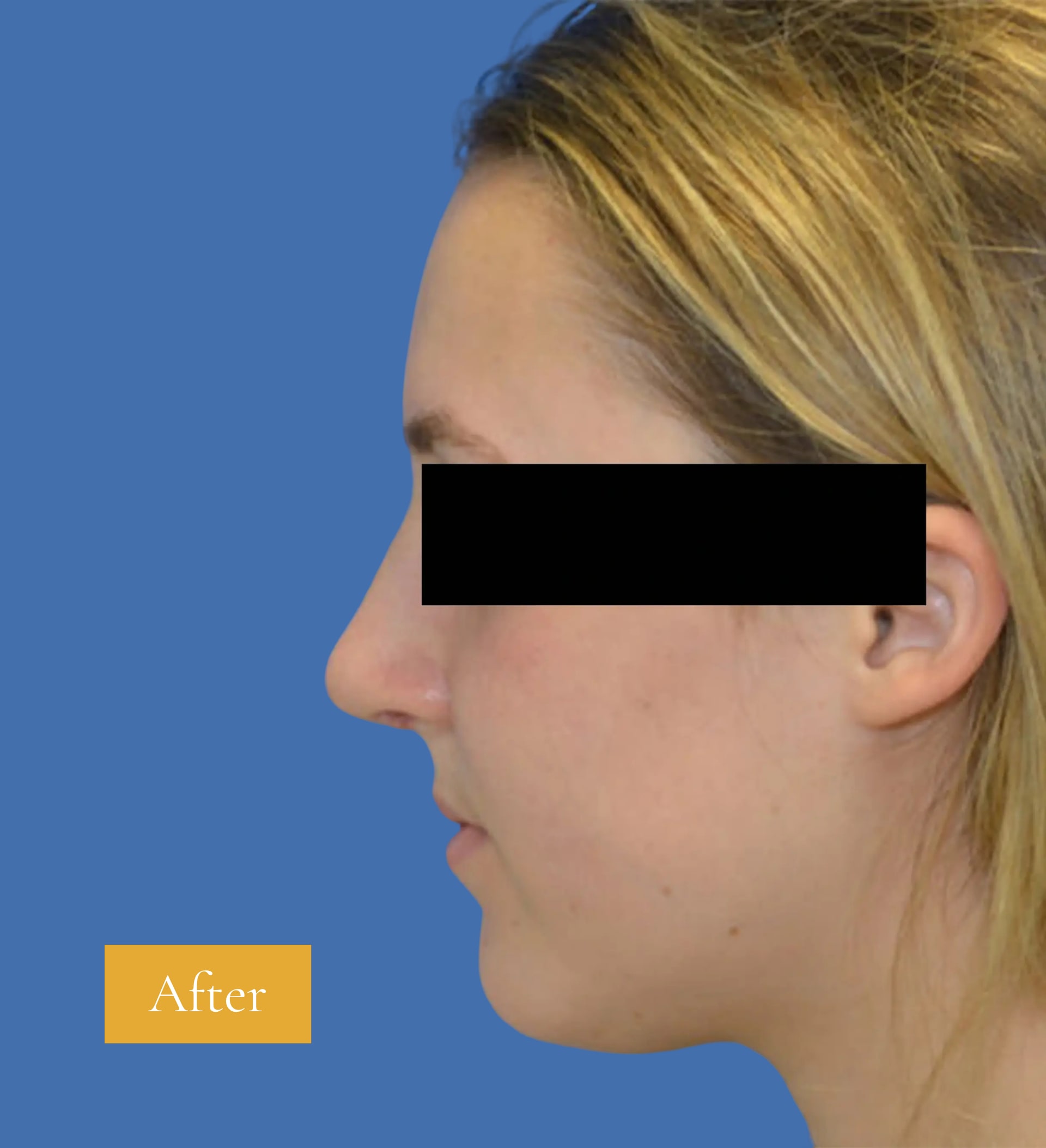 After Rhinoplasty before and after