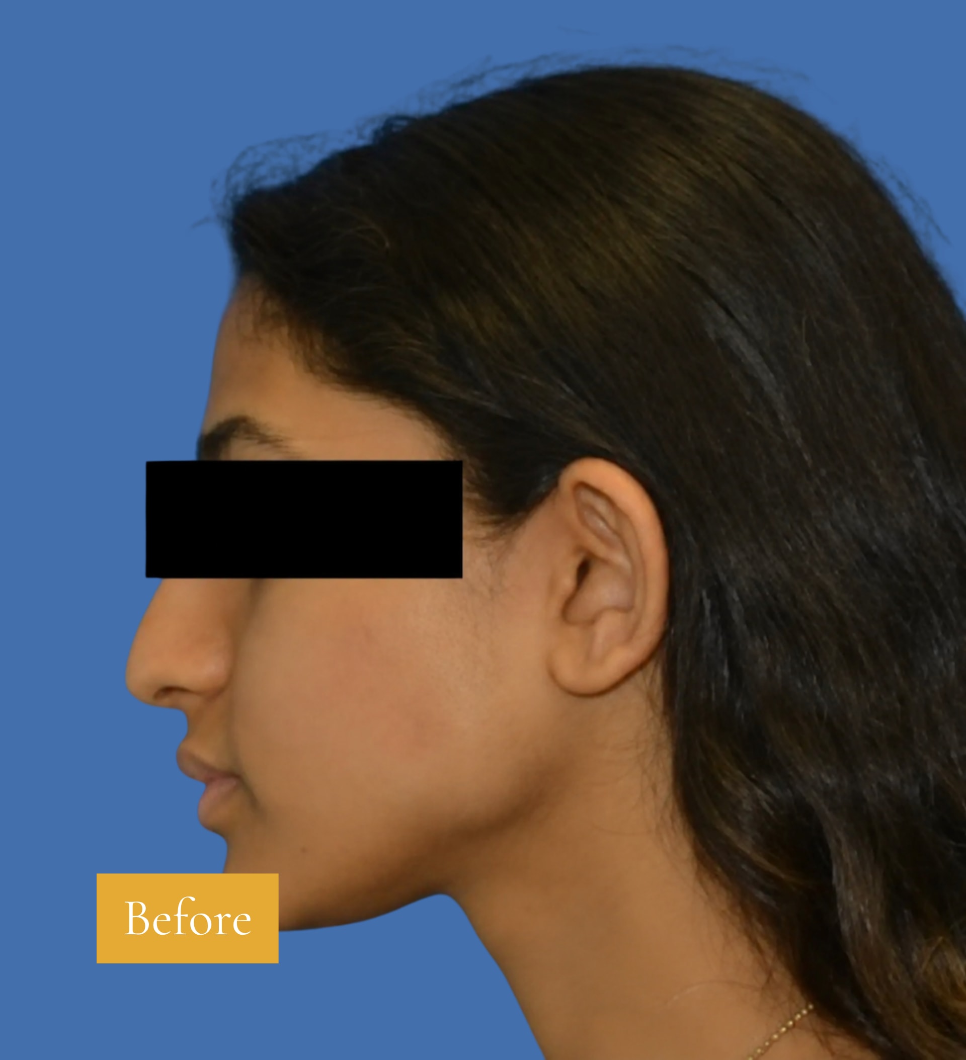Before Rhinoplasty before and after