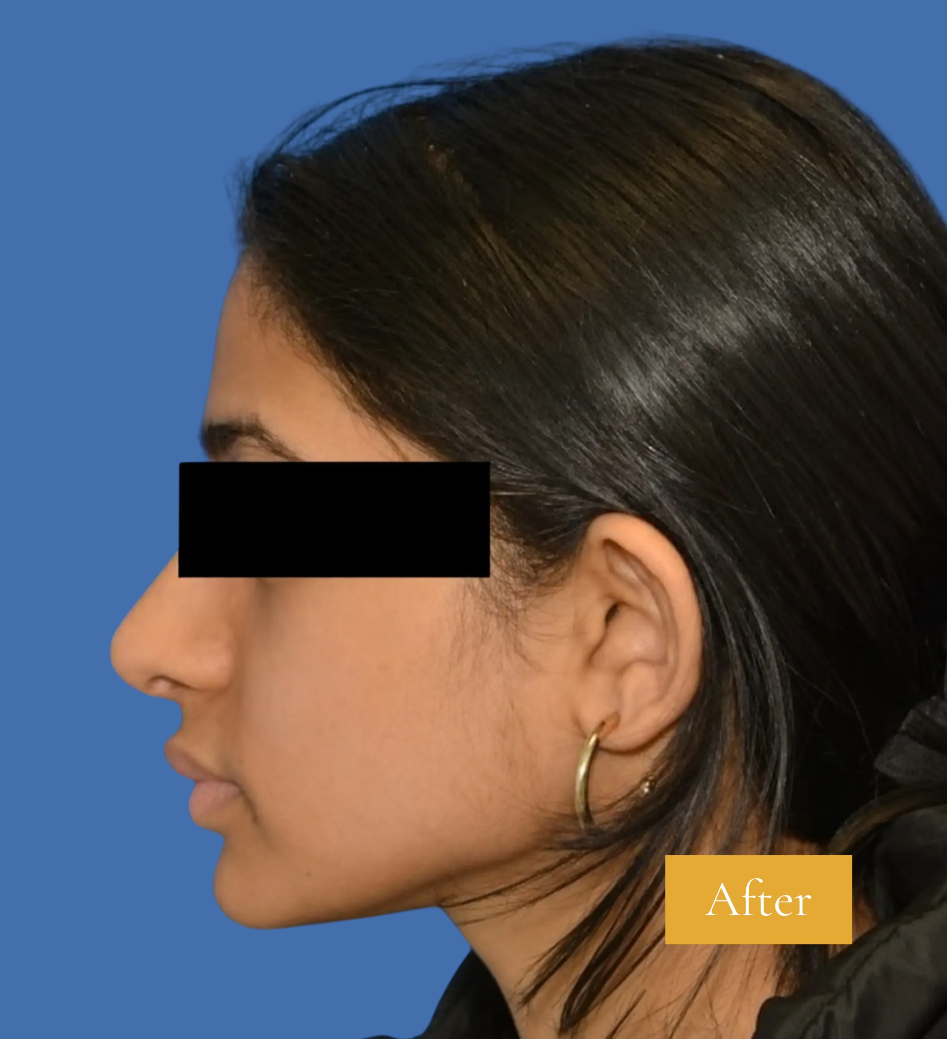 After Rhinoplasty before and after