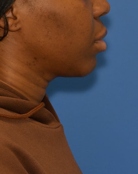 After Facelift before and after