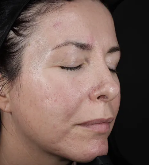 After AVAVA skin tightening laser after showing improved cheek skin texture and reduced redness.