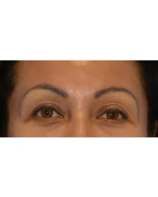 After Brow lift before and after