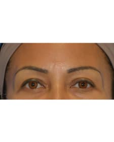 Before Brow lift before and after