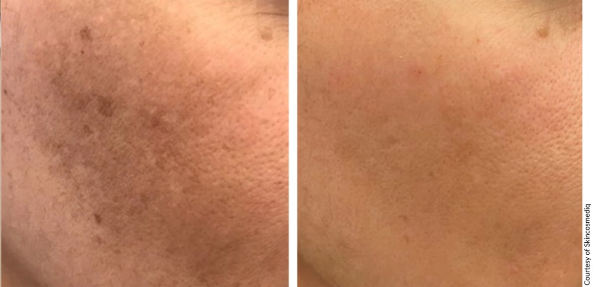 Before and after Alpha Pro IPL treatment showing reduced pigmentation and improved skin tone