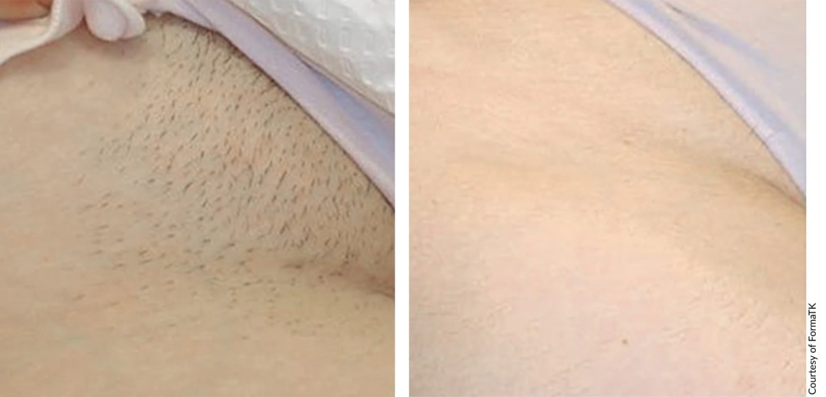 Before and after Alpha Pro Bright & Tight treatment showing clearer, more radiant skin