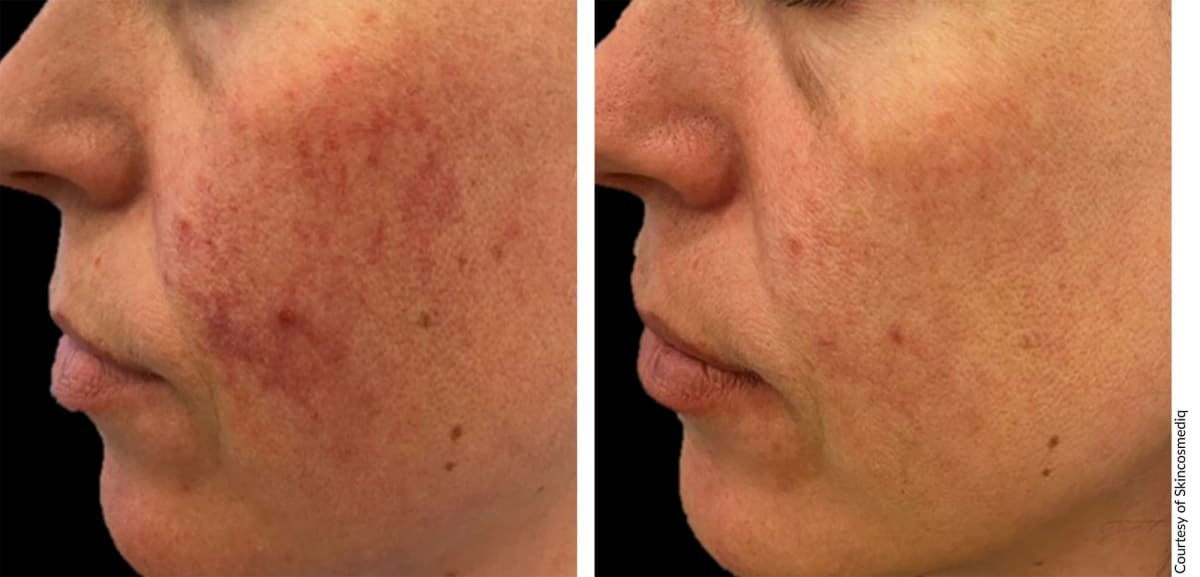 Before and after Alpha Pro laser hair removal treatment showing smooth, hair-free skin results