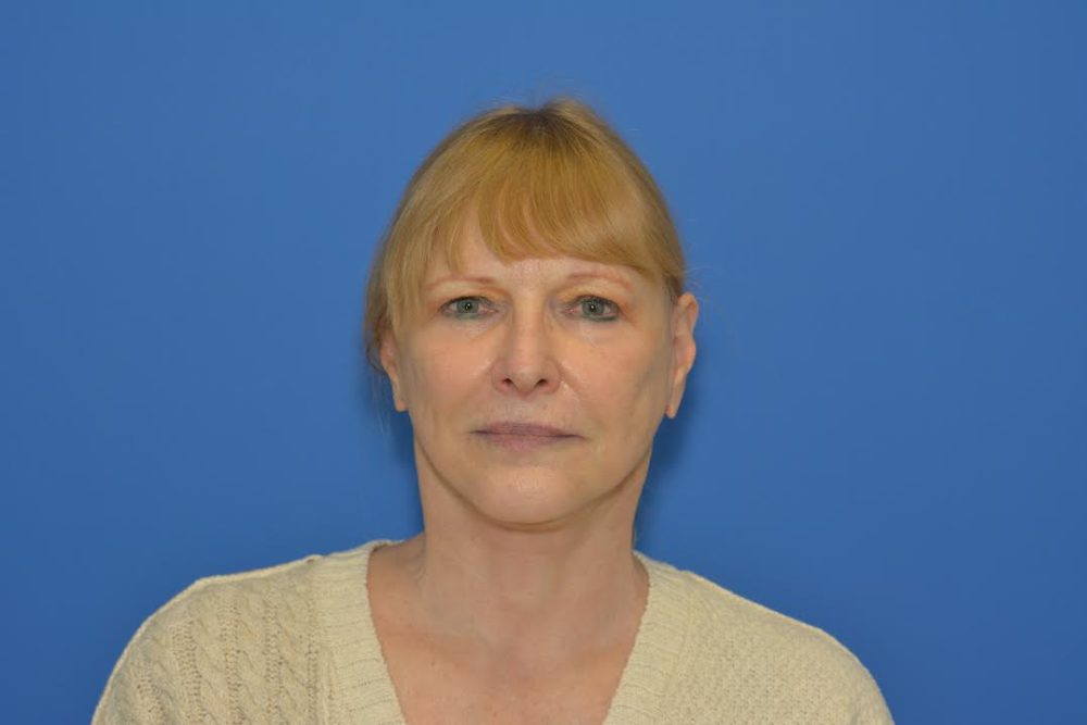 After Facelift before and after