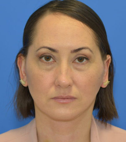 After Mini Facelift before and after