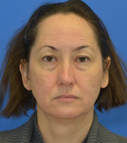 Before Mini Facelift before and after