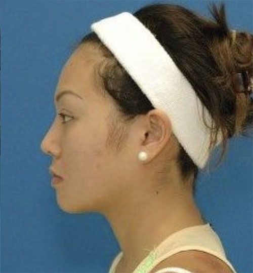 After Asian Rhinoplasty before and after