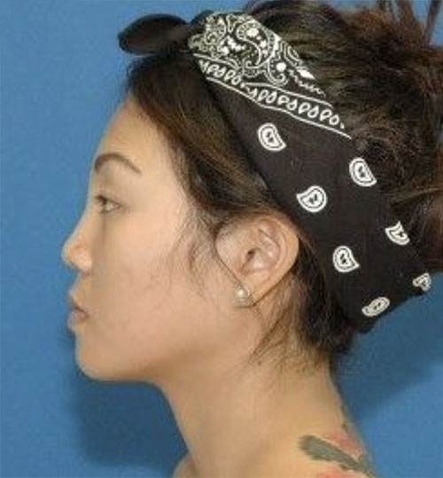 Before Asian Rhinoplasty before and after