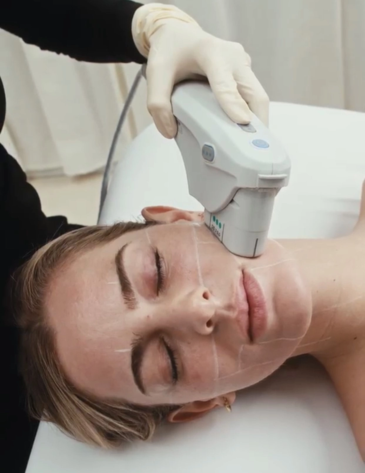 Woman undergoing Ultherapy procedure