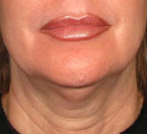 Before Ultherapy before and after