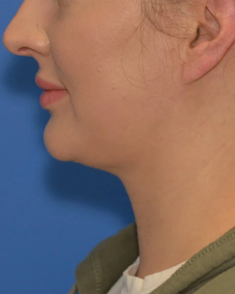After Kybella before and after results