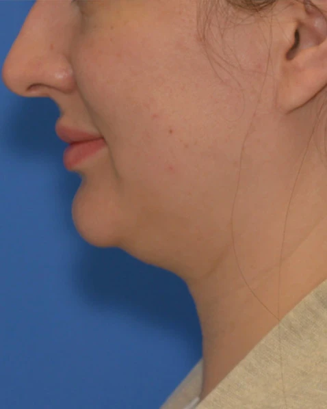 Before Kybella before and after results