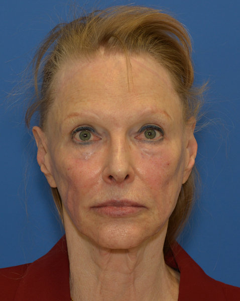Before Liquid Facelift before and after
