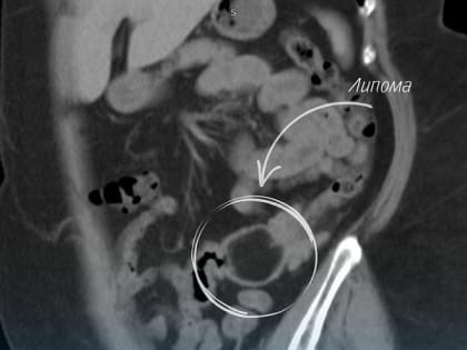 Успешное эндоскопическое удаление липомы у пациента в Нижневартовске