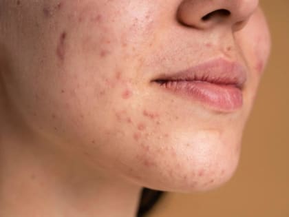 «Кожа будет идеальной». Россиянам рассказали о способе замедлить старение