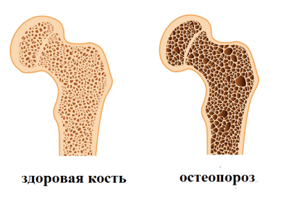 Чем можно заесть остеопороз