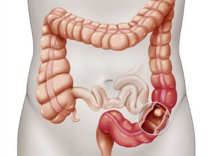 На колоректальный рак нашли управу