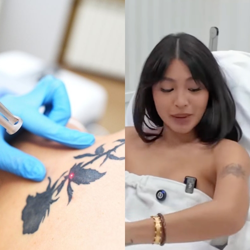 Laser tattoo removal explainer — Nadine Lustre had some tattoos removed at Aivee Clinic in 2025