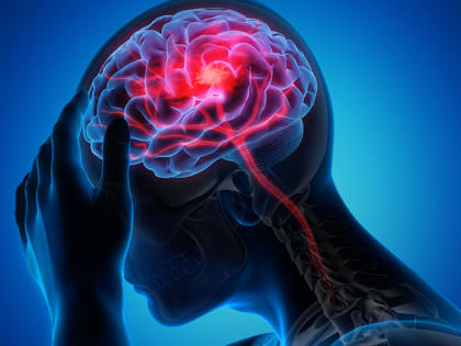 В России проходит Неделя борьбы с инсультом