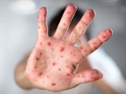 В Роспотребнадзоре объяснили отказами от вакцинации распространение кори в Дагестане