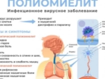 Полиомиелит: причины появления, симптомы, диагностика и способы лечения