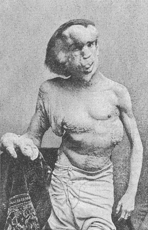 1890年 - ジョゼフ・メリック、「エレファント・マン」として知られる人物（* 1862年）