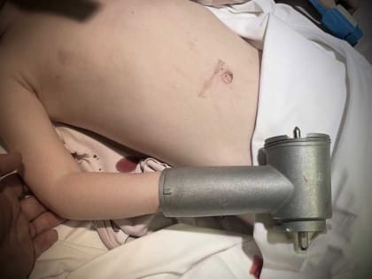 Воронежские врачи достали руку ребенка из мясорубки