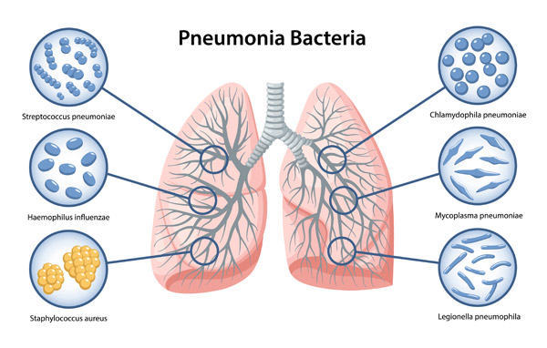 12 November Hari Pneumonia Sedunia Cek Gejala dan Cara Cegahnya 