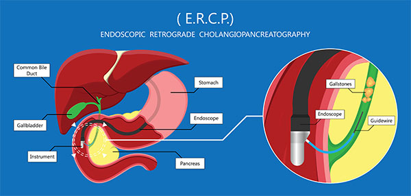 Endoscopic retrograde cholangiopancreatography